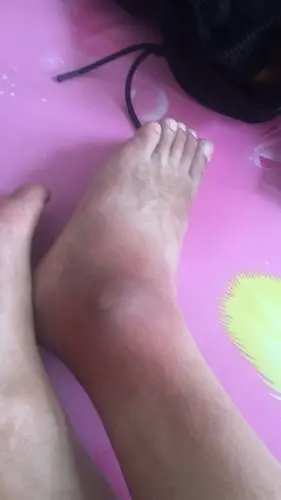 医生,您好.我爸爸前几天左脚踝突然就肿痛,不敢走路.去医院检