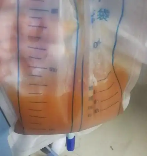 但是仅仅24小时左右,保大爷右侧胸腔积液大量增加,几乎填满了右半个