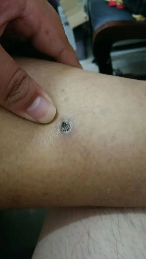 小腿上有个黑色凹陷的结痂,2个多月了