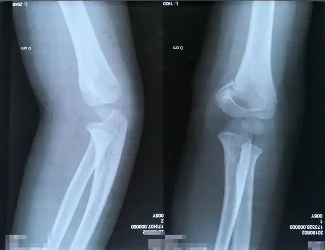 儿童创伤-内侧柱塌陷型肱骨髁上骨折的诊疗 - 好大夫在线