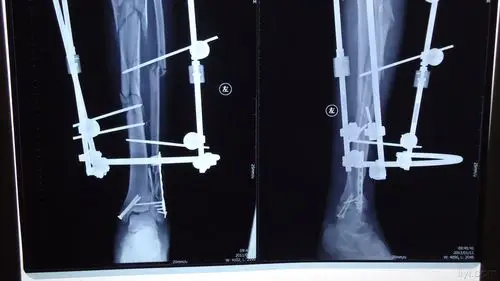 胫骨多段骨折外固定架固定