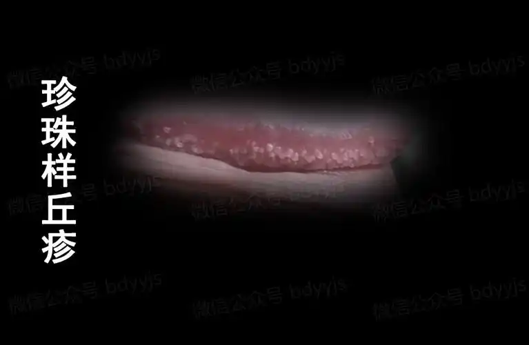 珍珠疹图片