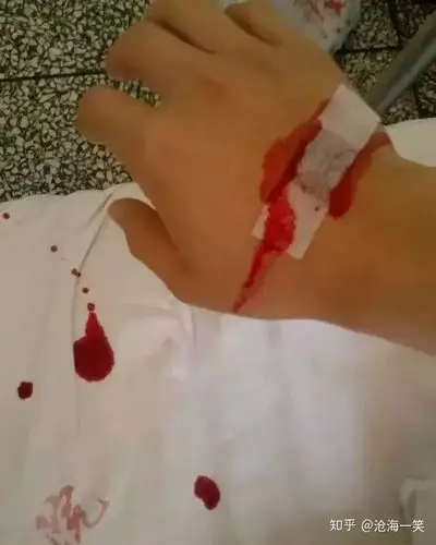 输液拔针后一定要对患者说的3句话!每次你都说了吗?