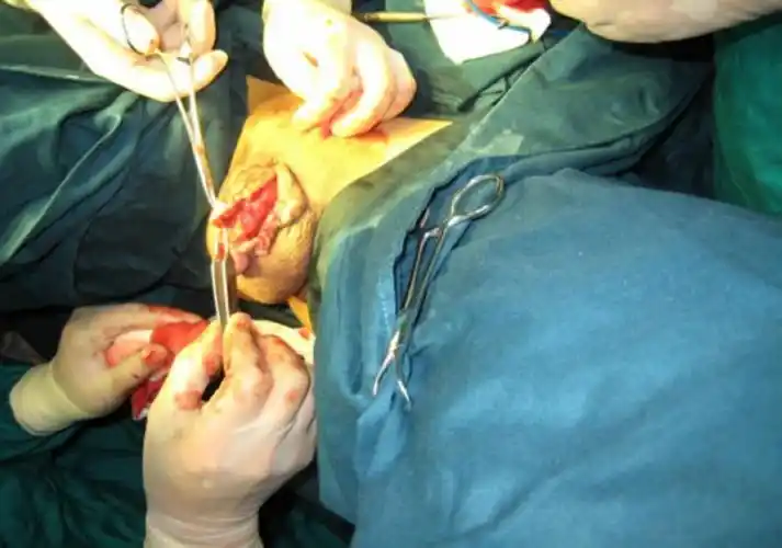 【转载】变性手术全过程,男变女(重口味不喜勿入)