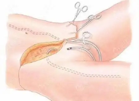 腹部拉皮手术有疤痕吗?伤口疤痕是不是非常大?