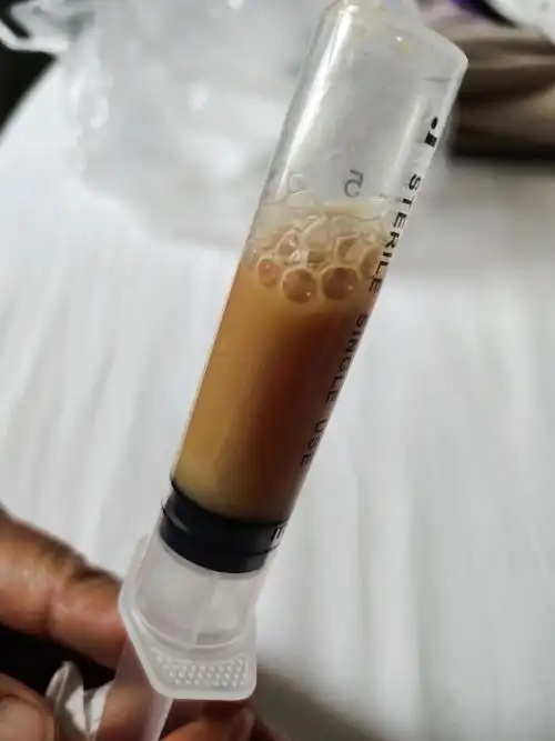 抽过胸腔积液后,我的情况好多了,不咳嗽也不发热.