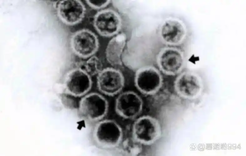 与人类疾病相关的疱疹病毒有8种: 1,单纯疱疹病毒1型(人类疱疹病毒1型