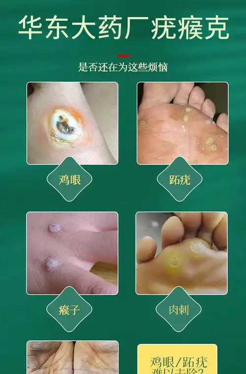 日本进口疣瘊克丘平疣去脖子腋下丝l状疣肉粒皮赘瘊丁坨疣进口疣瘊