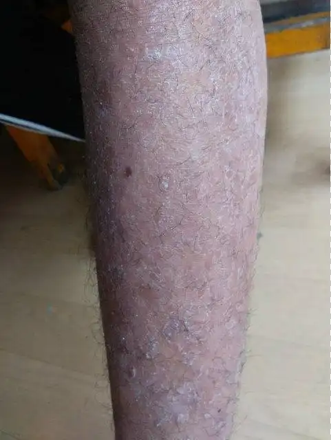 腿上有块状结痂皮癣图片