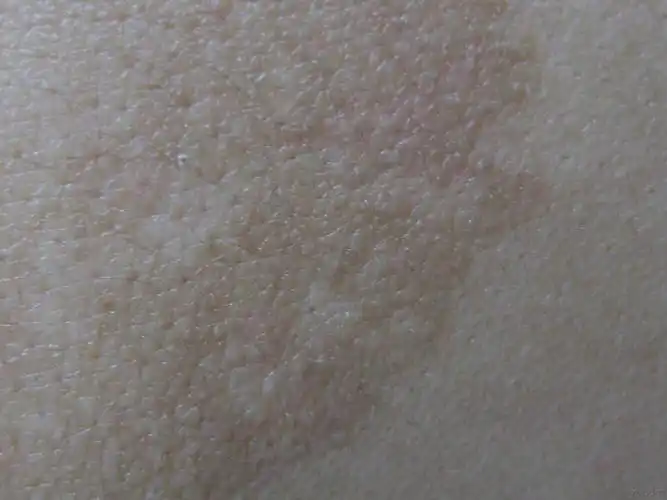 图片分享色素性毛表皮痣