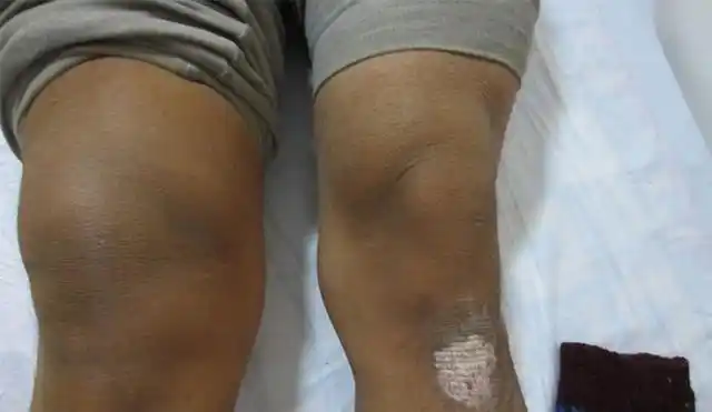 没想到白酒加香菜竟能逼走膝盖滑膜炎,治一个好一个,为家人收藏