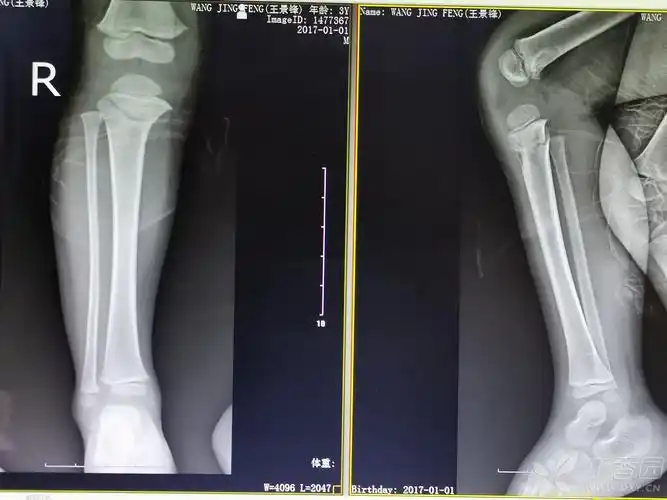 儿童胫骨近端骨折的非手术治疗.