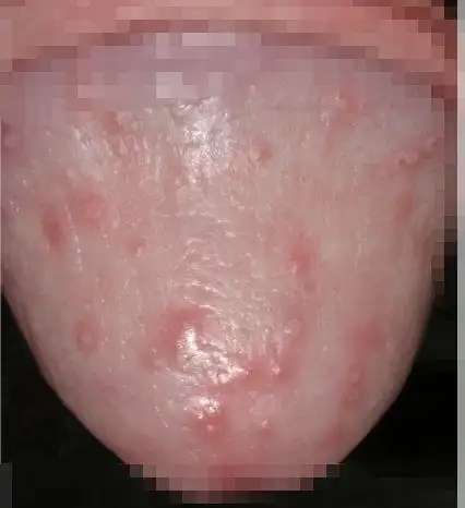 包皮发炎图片46