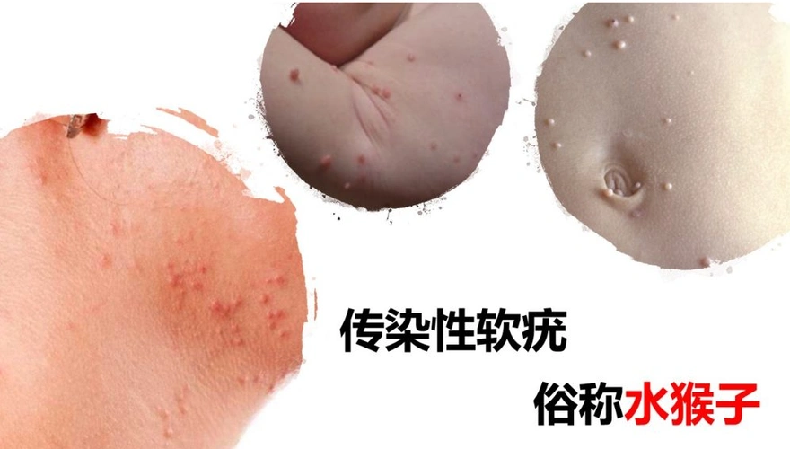 发现身体异样,请及时就诊_尖锐湿疣_尖锐湿疣介绍 - 好大夫在线