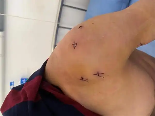 临床中所见到的大力水手肱二头肌长头腱断裂