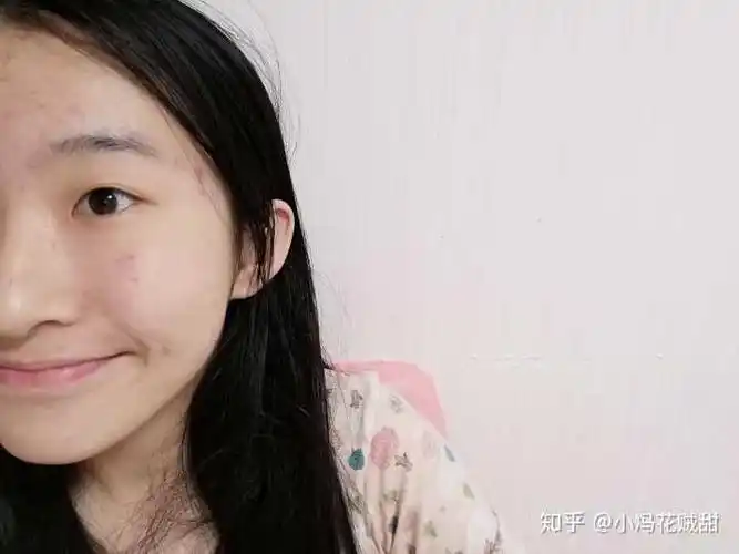 话不多说 放图 左边脸不笑 (忽略痘痘)懒得p掉了 以前只知道脸上窝窝