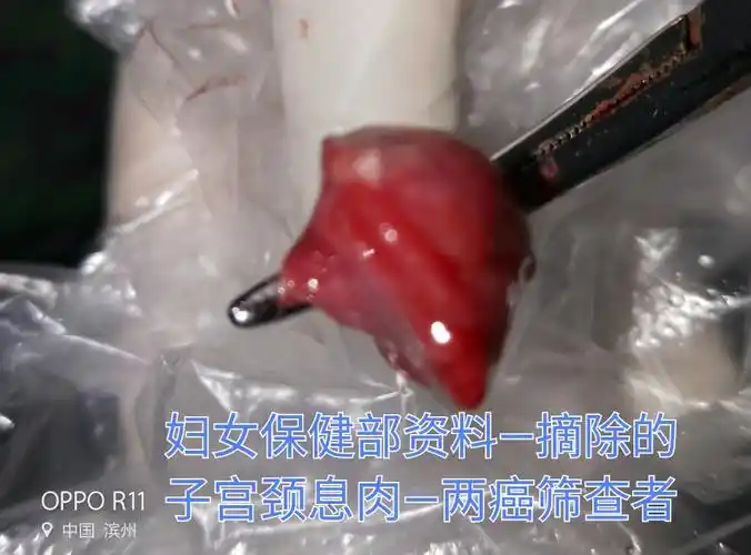 73发现宫颈息肉不及时治疗相当于姑息养奸73