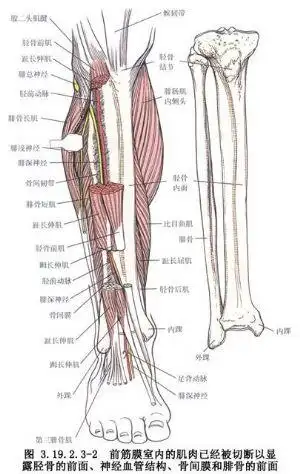 外固定技术加压固定,胫骨近端截骨延长术