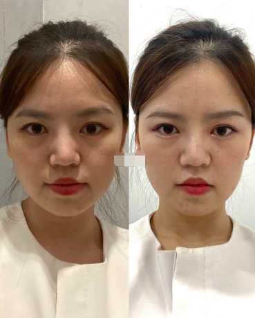 热玛吉前后效果对比图差别大吗,热玛吉副作用多吗